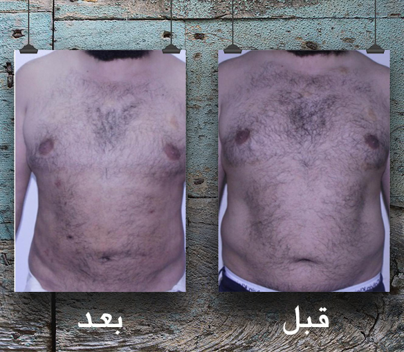 اسباب التثدي عند الرجال